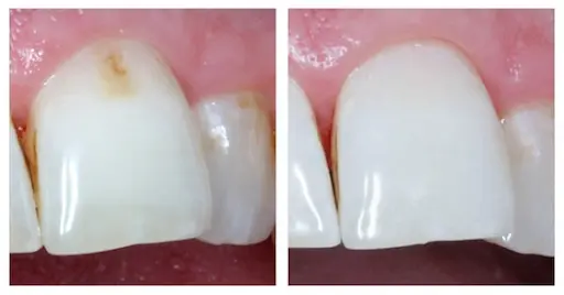 Лечение зубов без сверления в медцентре