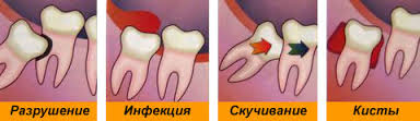 показания к удалению зуба мудрости
